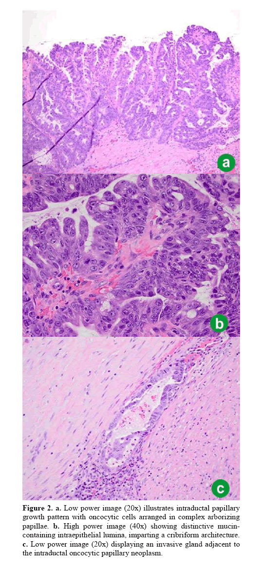 pancreas-illustrates-intraductal-papillary