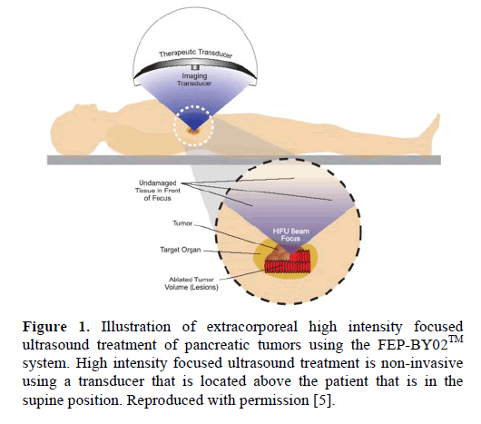 pancreas-illustration-extracorporeal-high