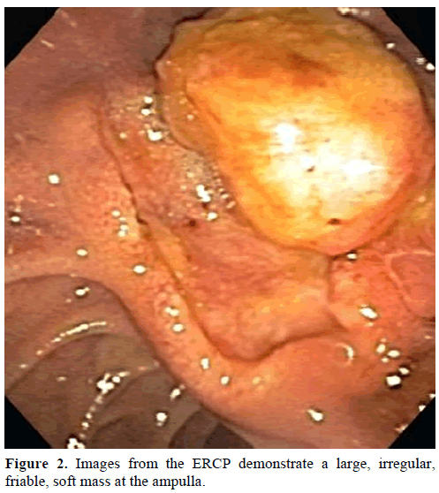 pancreas-images-ercp-demonstrates-large