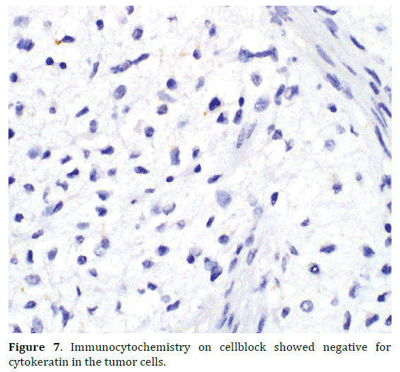 pancreas-immunocytochemistry-cytokeratin-tumor