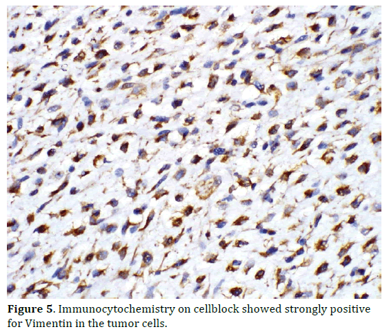 pancreas-immunocytochemistry-vimentin-tumor