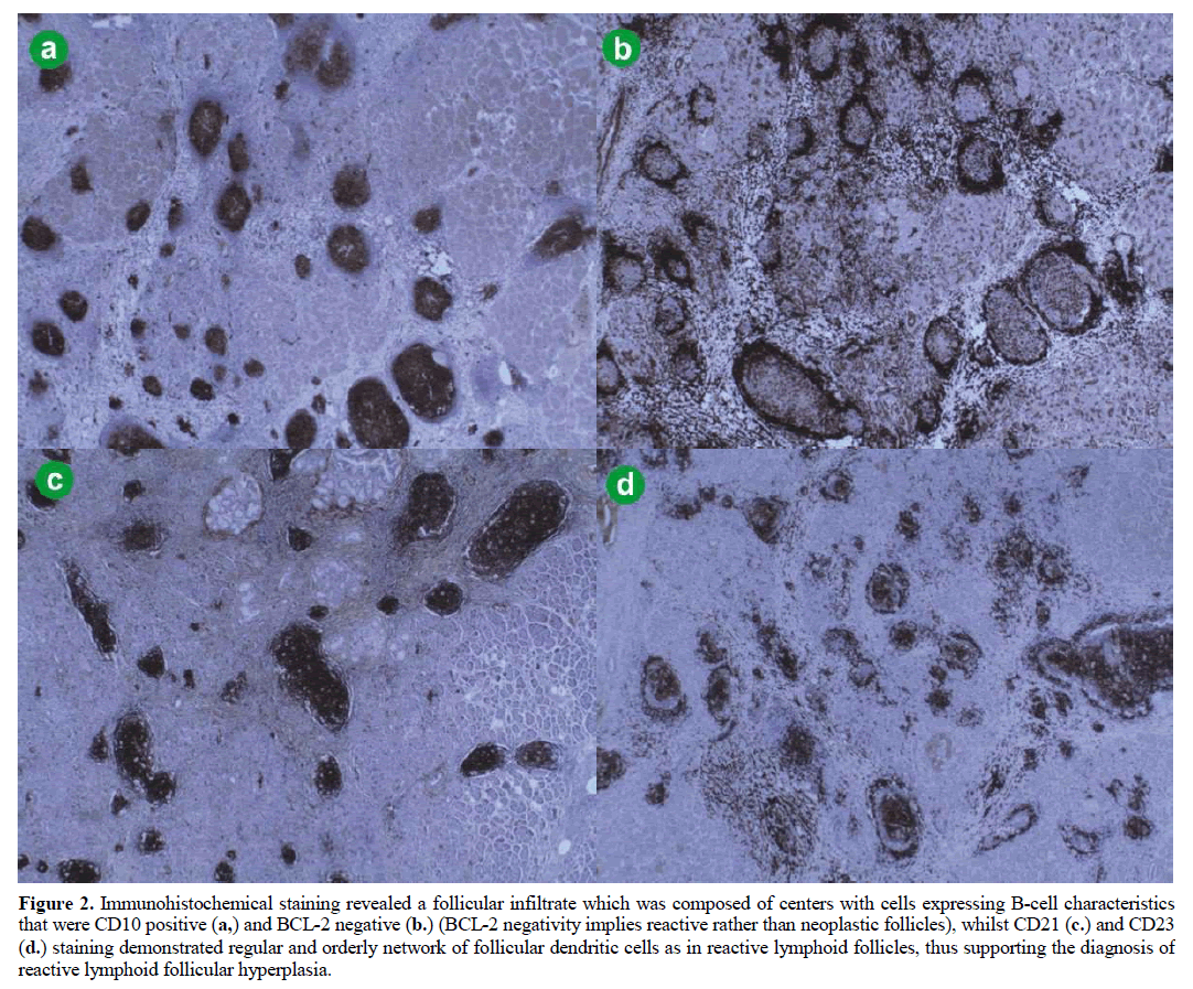 pancreas-immunohistochemical-follicular-infiltrate