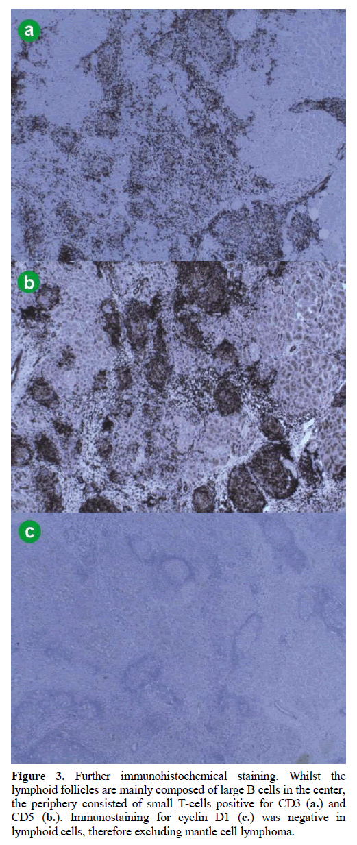 pancreas-immunohistochemical-lymphoid-follicles