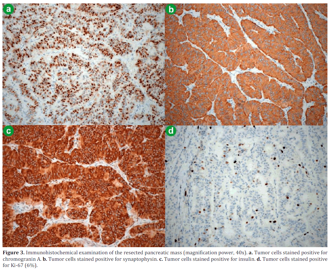 pancreas-immunohistochemical-resected