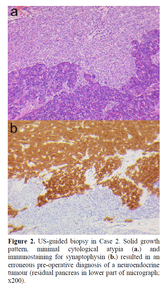 pancreas-immunostaining-synaptophysin