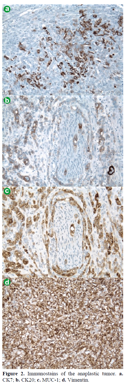 pancreas-immunostains-anaplastic