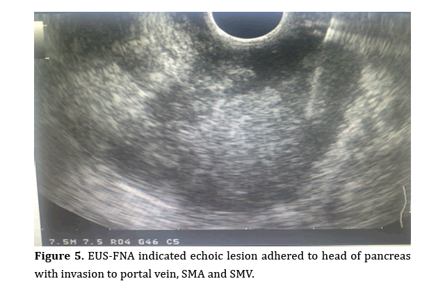 pancreas-indicated-echoic-lesion