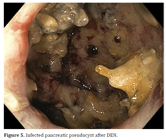 pancreas-infected-pancreatic