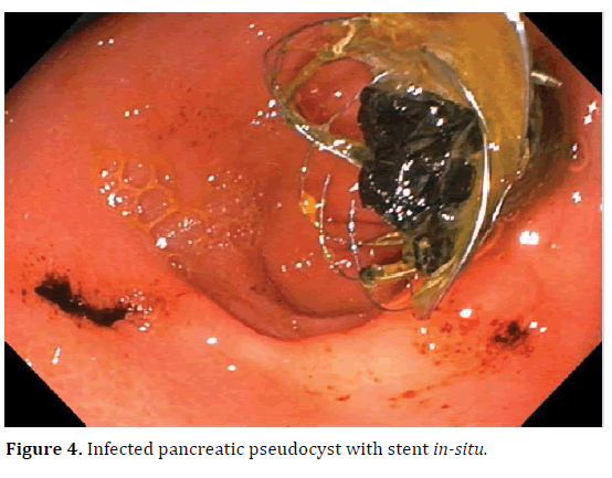 pancreas-infected-pancreatic