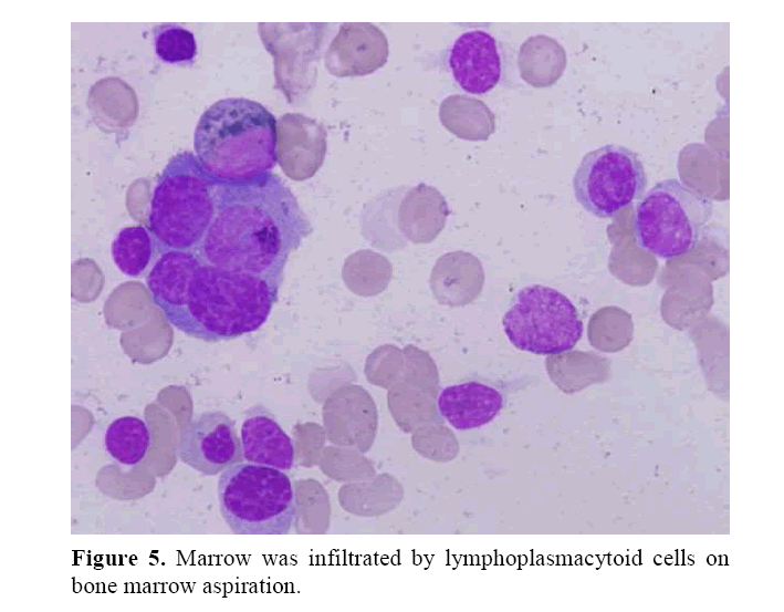 pancreas-infiltrated-lymphoplasmacytoid