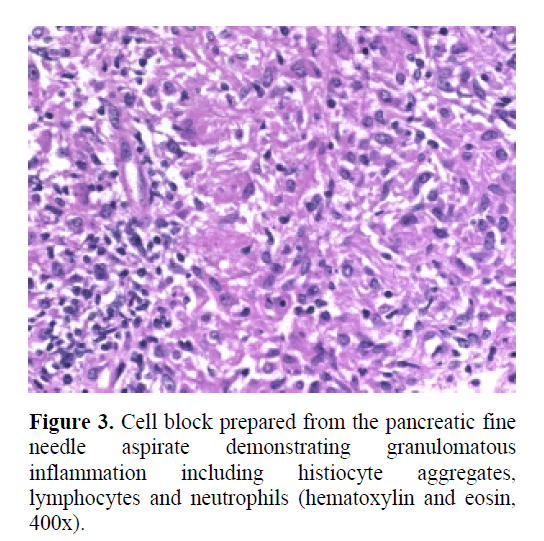 pancreas-inflammation-including-histiocyte
