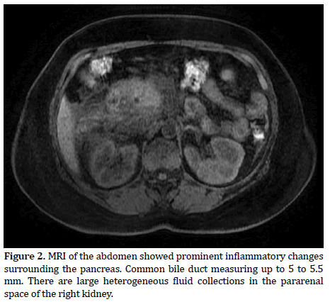 pancreas-inflammatory-changes