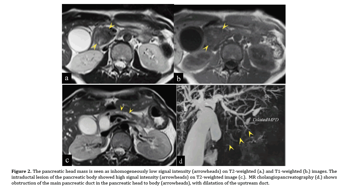 pancreas-inhomogeneously-low-signal