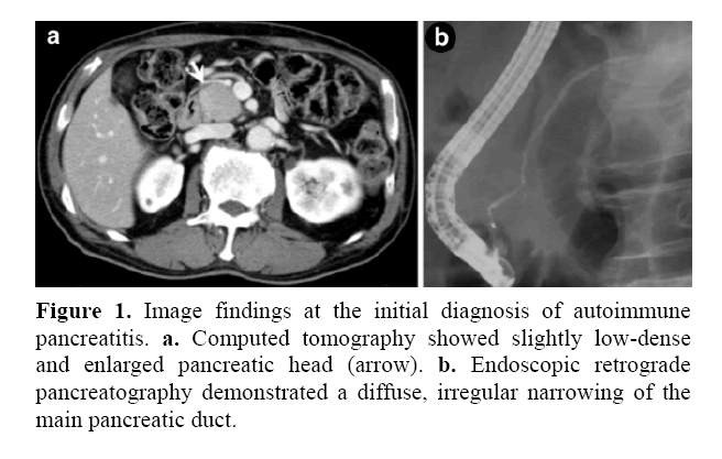 pancreas-initial-diagnosis-autoimmune