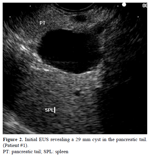 pancreas-initial-eus-pancreatic-tail