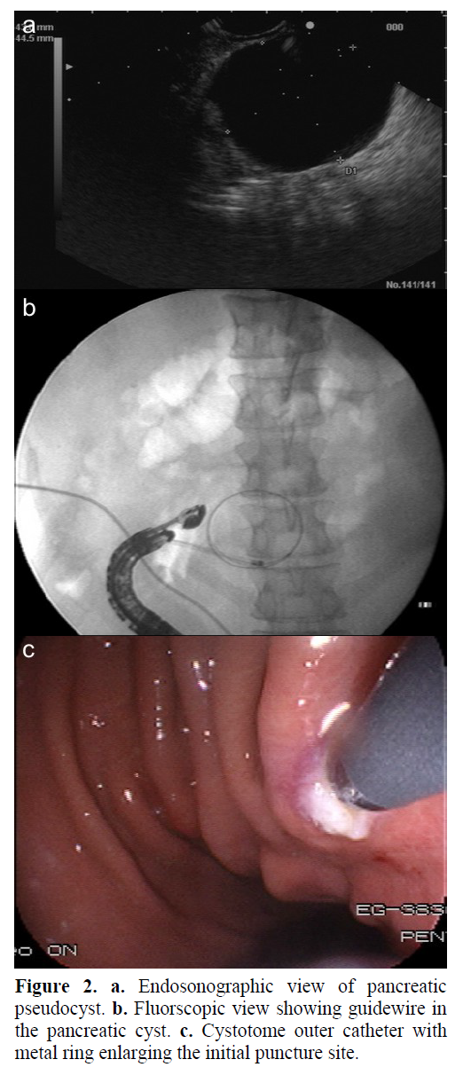 pancreas-initial-puncture-site