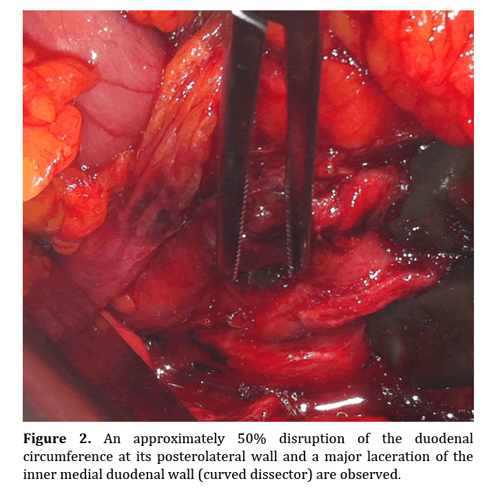 pancreas-inner-medial-duodenal