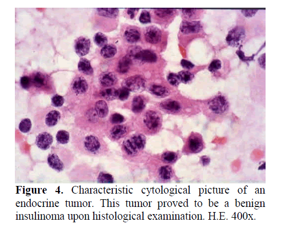 pancreas-insulinoma-upon-histological