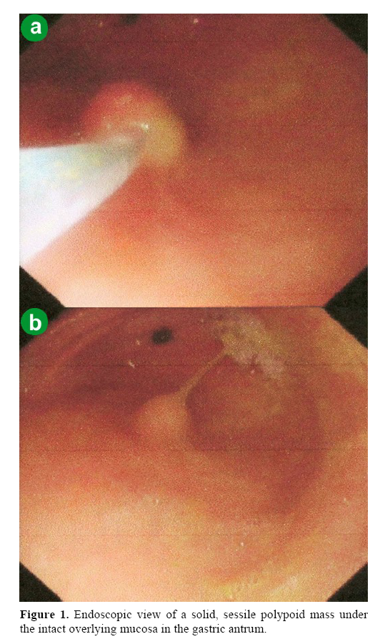 pancreas-intact-overlying-mucosa