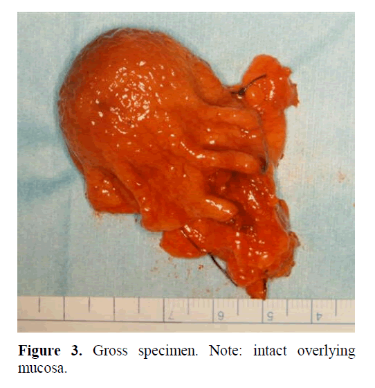 pancreas-intact-overlying-mucosa