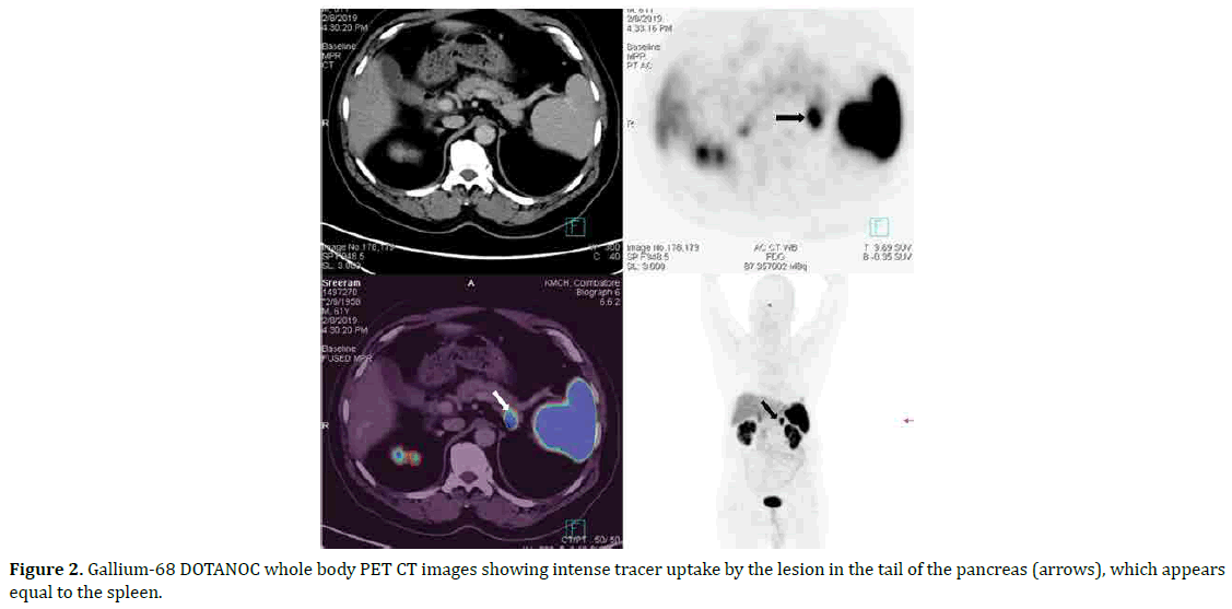 pancreas-intense-tracer-uptake