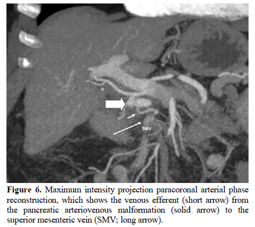 pancreas-intensity-projection-paracoronal