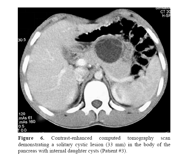 pancreas-internal-daughter-cysts