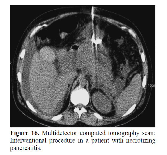 pancreas-interventional-procedure-patient