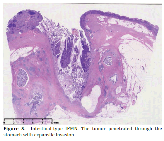 pancreas-intestinal-type-ipmn