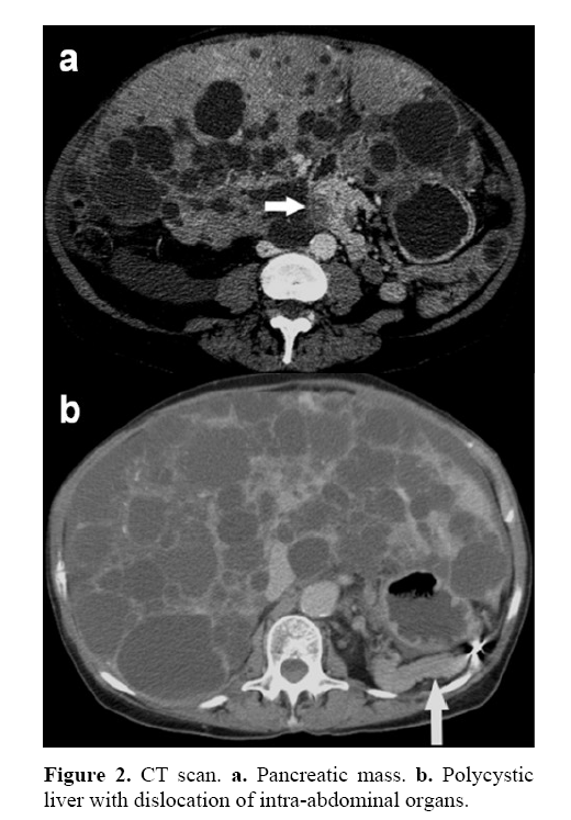 pancreas-intra-abdominal-organs