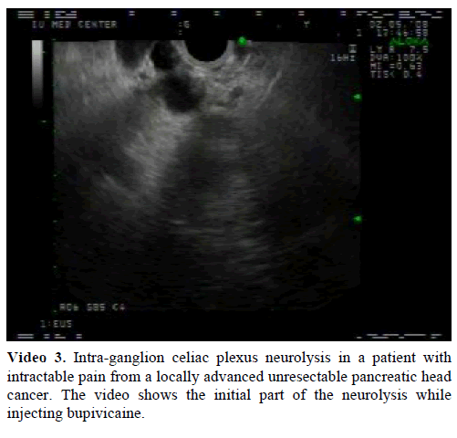 pancreas-intra-ganglion-celiac-plexus