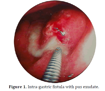 pancreas-intra-gastric-fistula