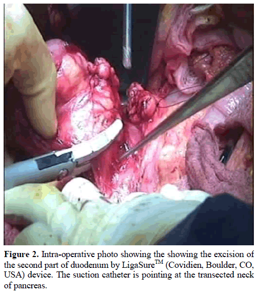 pancreas-intra-operative-photo-excision