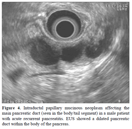 pancreas-intraductal-papillary-mucinous