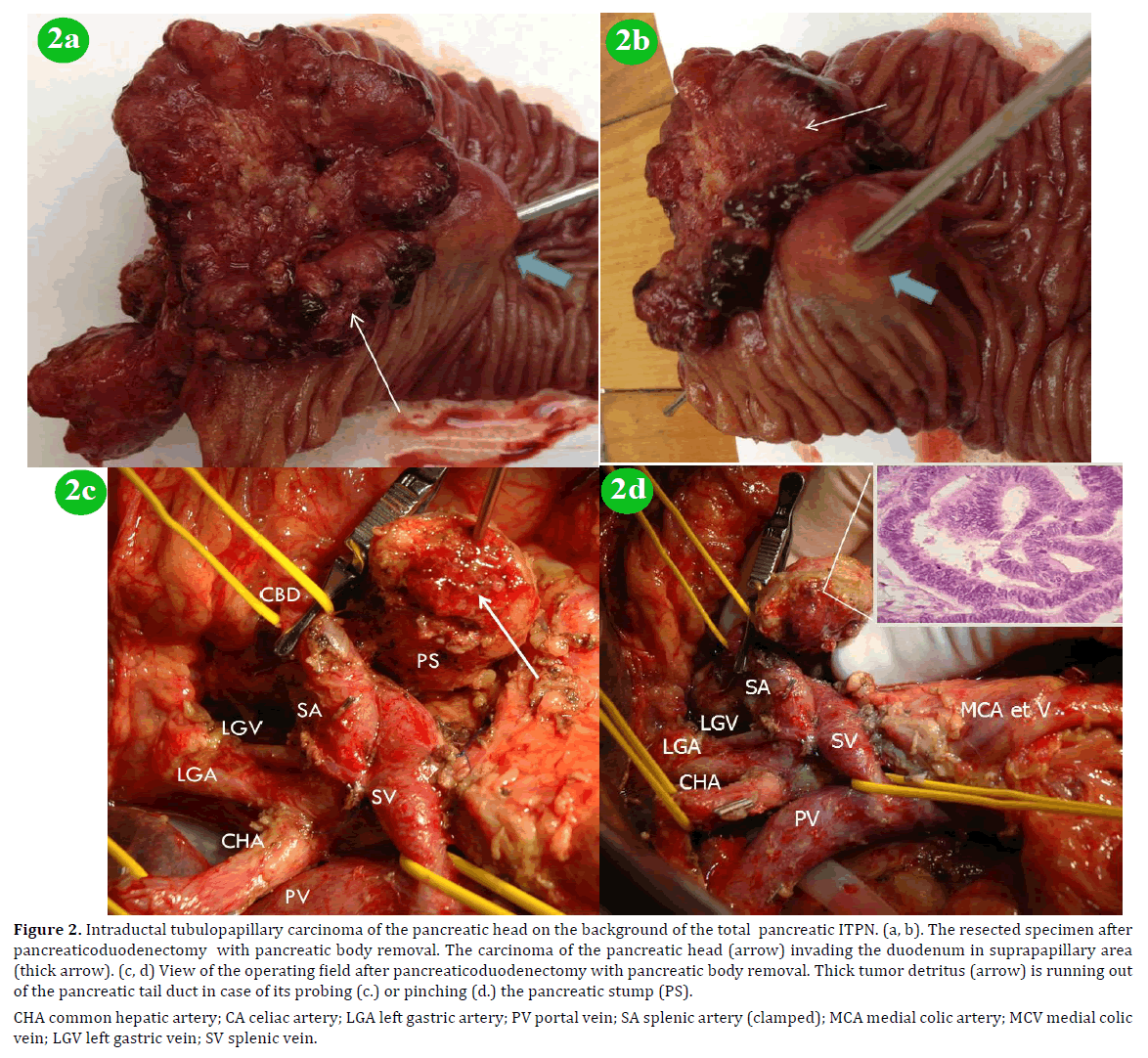 pancreas-intraductal-tubulopapillary-carcinoma