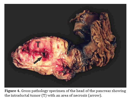 pancreas-intraductal-tumor
