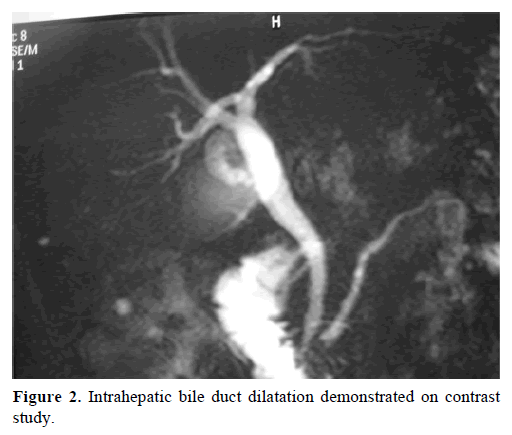 pancreas-intrahepatic-bile-duct-dilatation