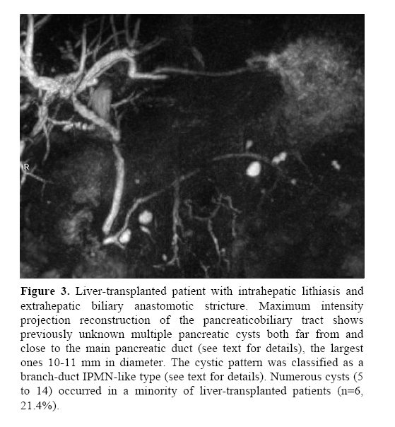 pancreas-intrahepatic-lithiasis