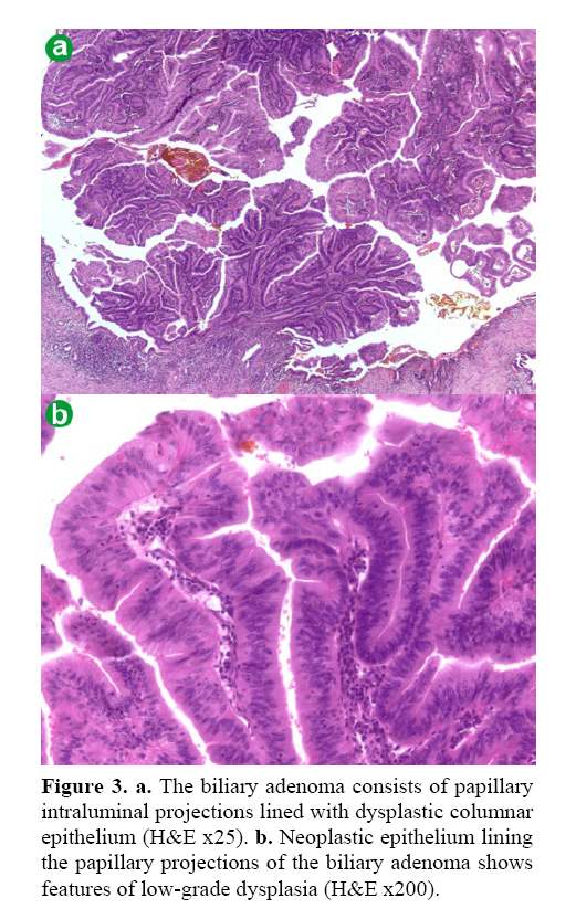 pancreas-intraluminal-projections