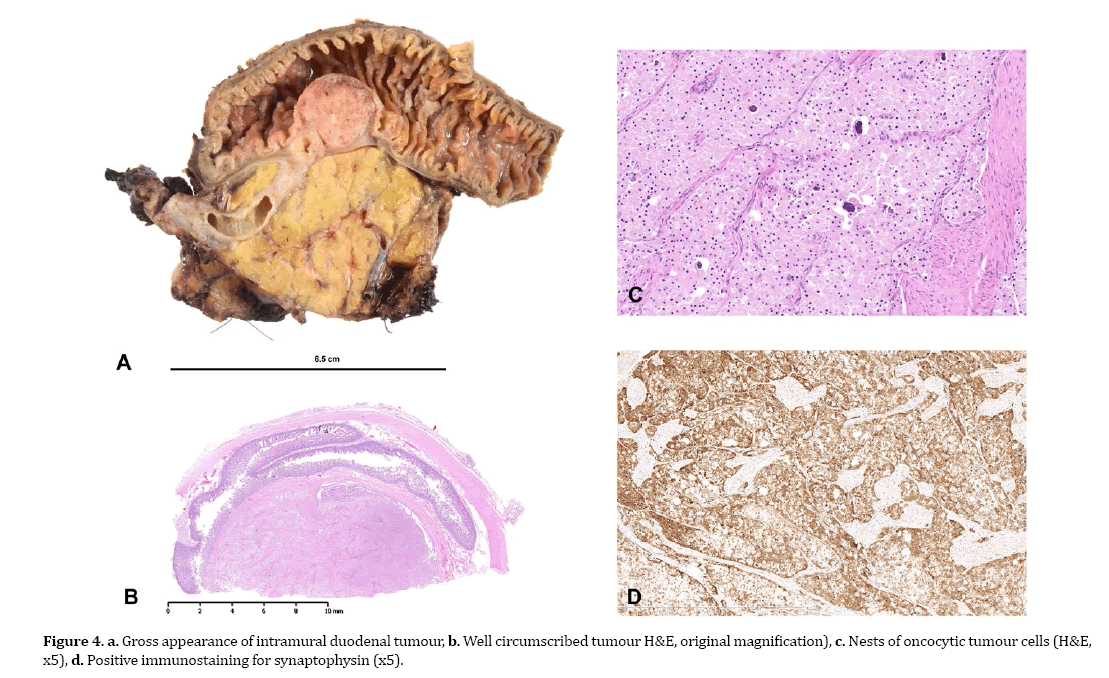 pancreas-intramural-duodenal-tumour