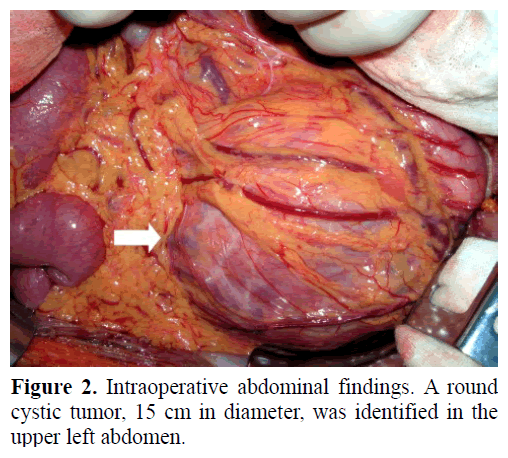 pancreas-intraoperative-abdominal-findings