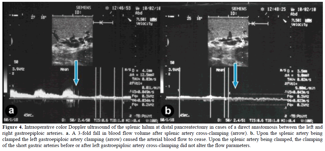 pancreas-intraoperative-color-doppler