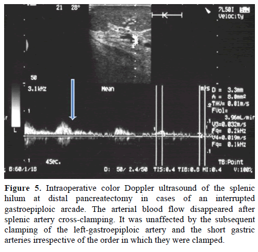 pancreas-intraoperative-color-ultrasound
