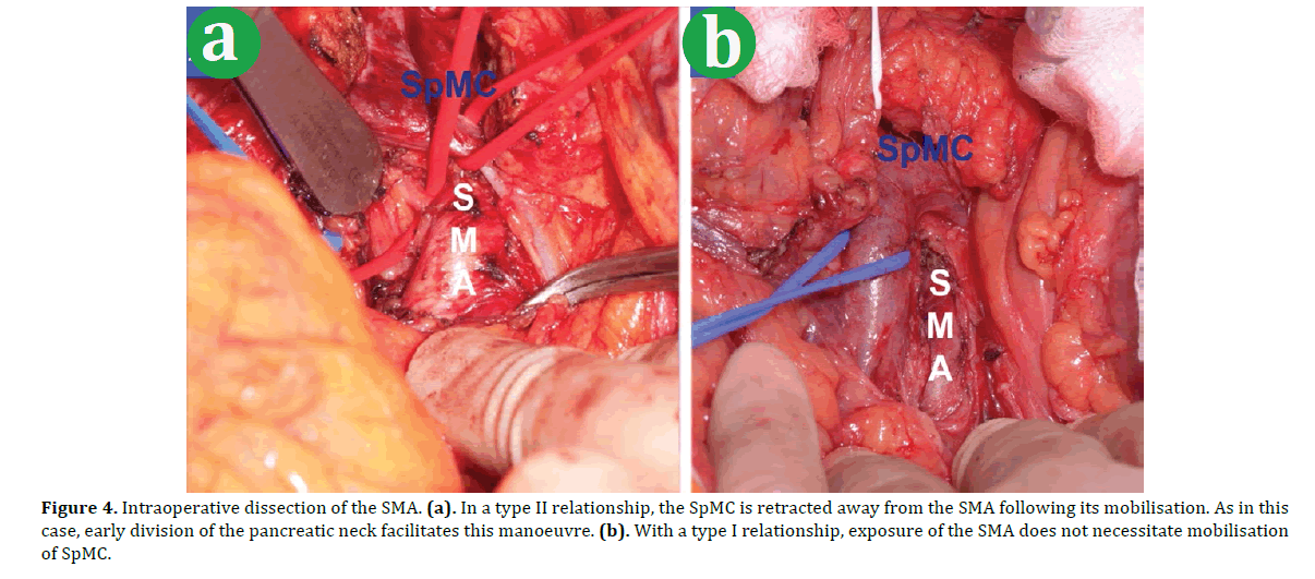 pancreas-intraoperative-dissection