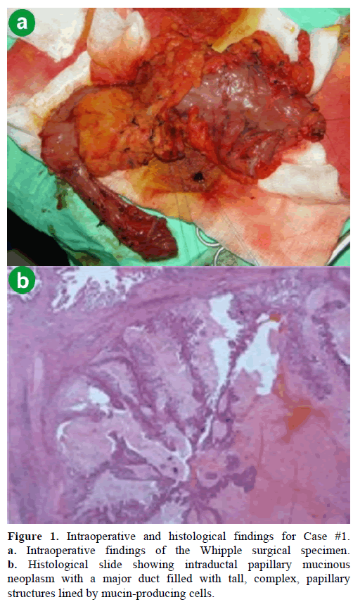 pancreas-intraoperative-histological-findings