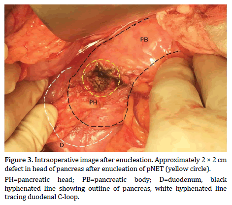 pancreas-intraoperative-image