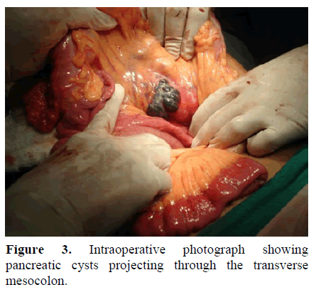 pancreas-intraoperative-photograph-cysts