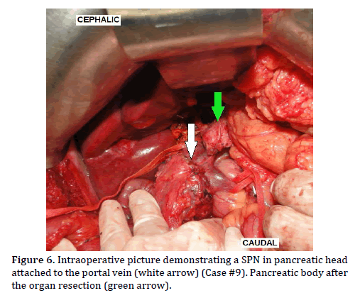 pancreas-intraoperative-picture-attached
