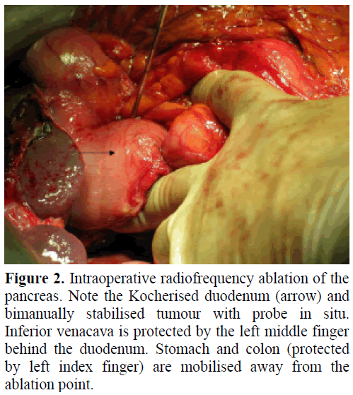 pancreas-intraoperative-radiofrequency