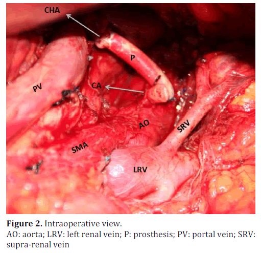 pancreas-intraoperative-renal-vein